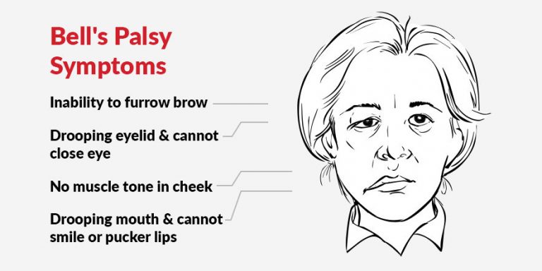 Bell S Palsy My Complete Balance